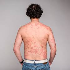 Auto Immune Disease (The Menace Of Self-Protest) – 1