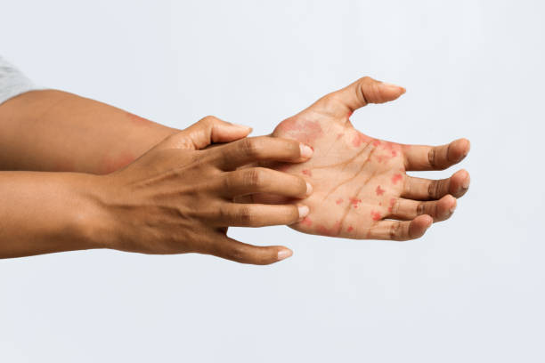 Everything You Should Know About Hand, Foot, and Mouth Disease