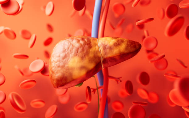 Fatty Liver In Non-Drinkers: Unravel, Crack The Code!