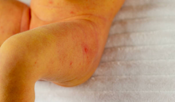 Jaundice in Newborns: When to Worry and how it’s treated