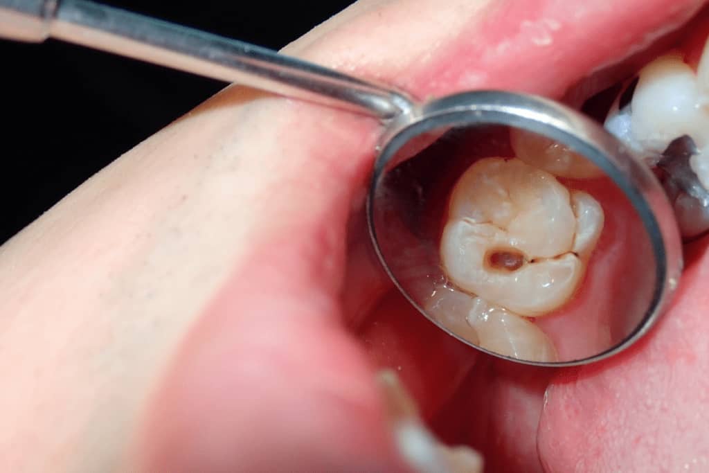 Researchers Discover an Easy Way to Halt Cavities without Drilling