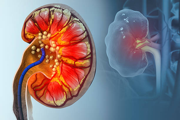 How to Prevent Kidney Stones: 7 Habits That Can Help